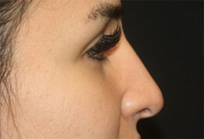 Rhinoplasty Before & After Patient #27163