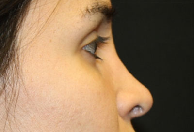 Rhinoplasty Before & After Patient #27163