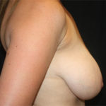 Breast Reduction Before & After Patient #27122