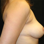 Breast Reduction Before & After Patient #27122