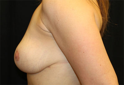 Breast Reduction Before & After Patient #27122