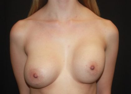 Breast Lift with Implant Before & After Patient #27587