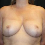 Breast Reduction Before & After Patient #27555