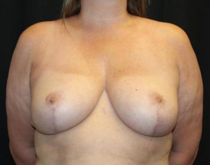 Breast Reduction Before & After Patient #27555