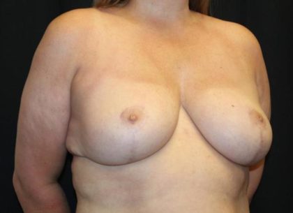 Breast Reduction Before & After Patient #27555