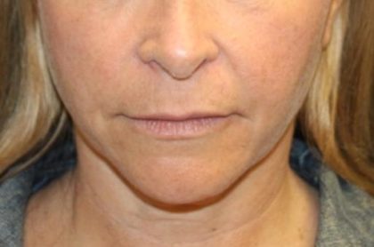 Injectable Fillers Before & After Patient #27643