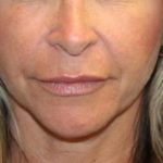 Injectable Fillers Before & After Patient #27643