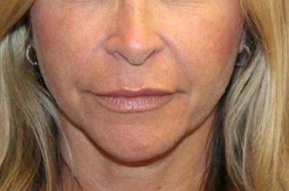 Injectable Fillers Before & After Patient #27643