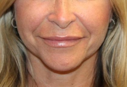 Injectable Fillers Before & After Patient #27643