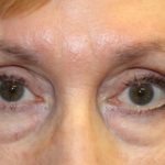 Blepharoplasty Before & After Patient #27740