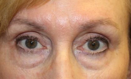 Blepharoplasty Before & After Patient #27740