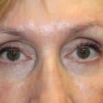 Blepharoplasty Before & After Patient #27740