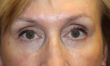 Blepharoplasty Before & After Patient #27740