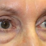 Blepharoplasty Before & After Patient #27740