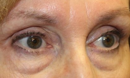 Blepharoplasty Before & After Patient #27740