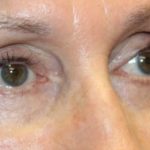 Blepharoplasty Before & After Patient #27740