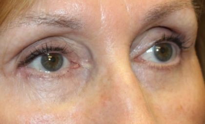 Blepharoplasty Before & After Patient #27740