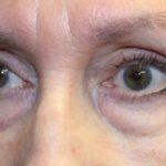 Blepharoplasty Before & After Patient #27740