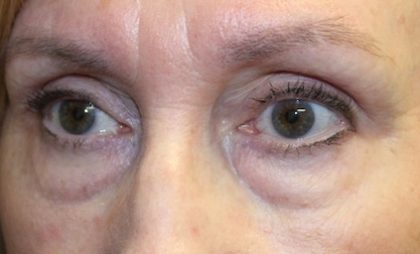 Blepharoplasty Before & After Patient #27740