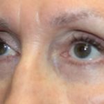 Blepharoplasty Before & After Patient #27740