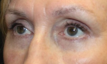 Blepharoplasty Before & After Patient #27740