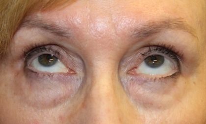 Blepharoplasty Before & After Patient #27740