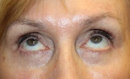 Blepharoplasty Before & After Patient #27740