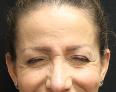Botox and Dysport Before & After Patient #27760