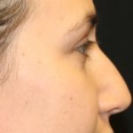 Rhinoplasty Before & After Patient #27769