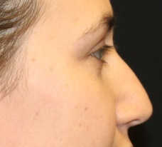 Rhinoplasty Before & After Patient #27769