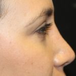Rhinoplasty Before & After Patient #27769