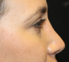 Rhinoplasty Before & After Patient #27769