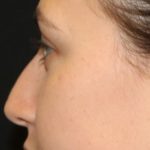 Rhinoplasty Before & After Patient #27769