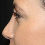 Rhinoplasty Before & After Patient #27769