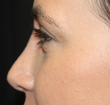 Rhinoplasty Before & After Patient #27769