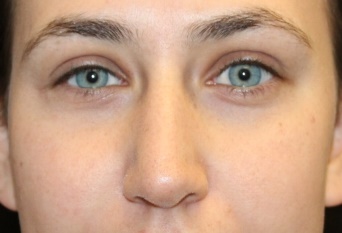 Rhinoplasty Before & After Patient #27769