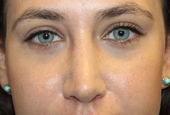 Rhinoplasty Before & After Patient #27769