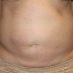 Tummy Tuck Before & After Patient #27780