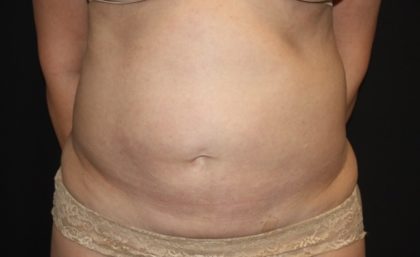 Tummy Tuck Before & After Patient #27780