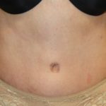 Tummy Tuck Before & After Patient #27780