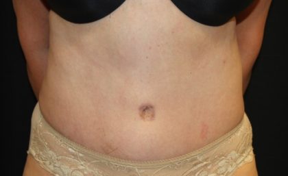 Tummy Tuck Before & After Patient #27780