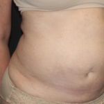 Tummy Tuck Before & After Patient #27780