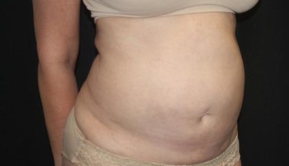 Tummy Tuck Before & After Patient #27780