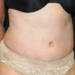 Tummy Tuck Before & After Patient #27780