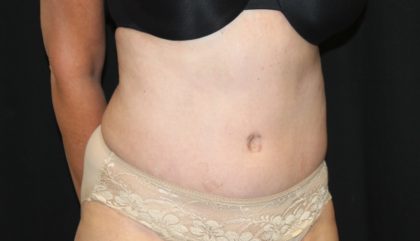 Tummy Tuck Before & After Patient #27780