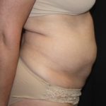 Tummy Tuck Before & After Patient #27780