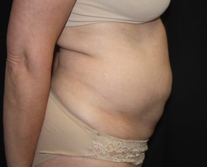 Tummy Tuck Before & After Patient #27780