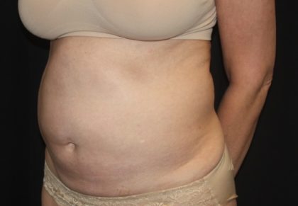 Tummy Tuck Before & After Patient #27780