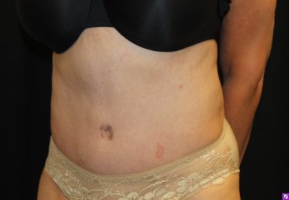 Tummy Tuck Before & After Patient #27780