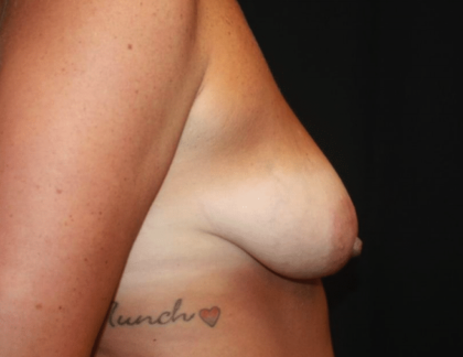 Breast Lift with Implant Before & After Patient #28051